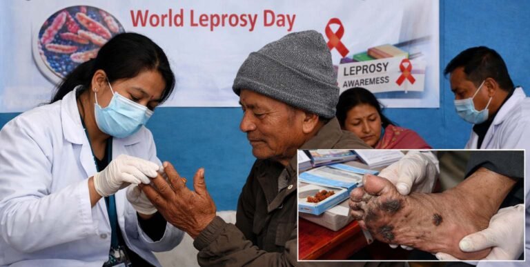 आज ७३ औँ विश्व कुष्ठरोग दिवस मनाइँदै